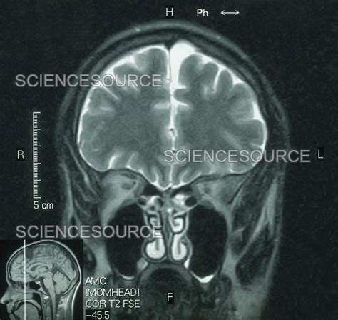 Photograph Mri Showing Arachnoid Cyst Science Source Images