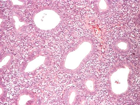 Simple Endometrial Hyperplasia Without Atypia With Moderate Diffuse