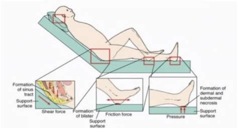 Pressure Wounds Flashcards Quizlet