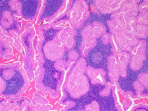 Pathology Outlines Warthin Tumor