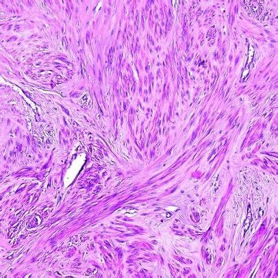 (PDF) Lipoleiomyoma in Myomatous Uterus