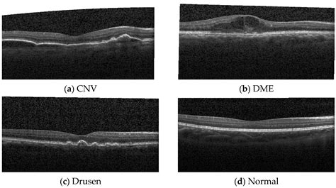 Macula Oct