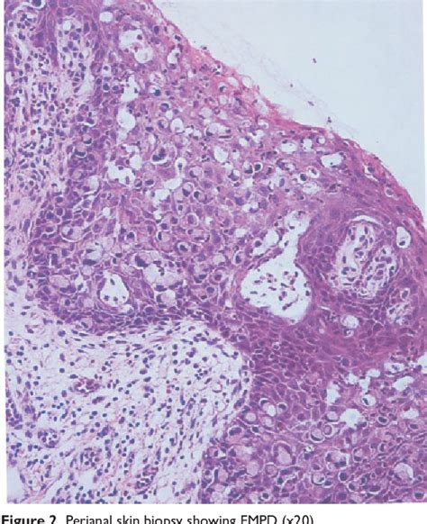 Figure 2 From A Peri Anal Extramammary Paget S Disease Associated With Two Well Differentiated