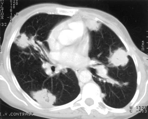 Amyloidosis And The Respiratory Tract Thorax