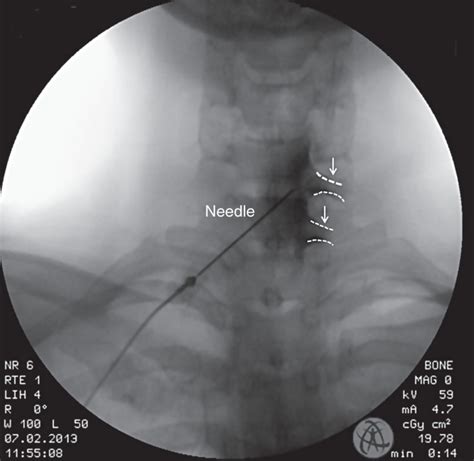 Comparison Of Contrast Flow And Clinical Effectiveness Between A Modified Paramedian