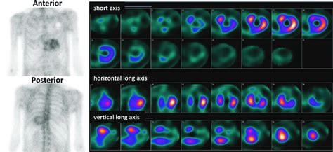 9 Planar And SPECT 99m Tc DPD Imaging The Planar Images Demonstrate