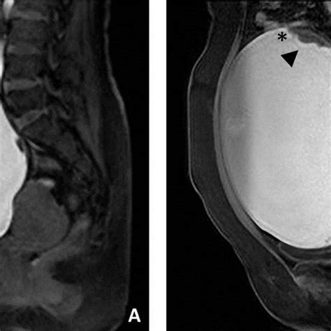 A Sagittal Enhanced T1 Weighted Magnetic Resonance Image Shows A Huge