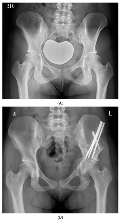 A Preoperative Anteroposterior Standing Radiograph Of A 19 Year Old