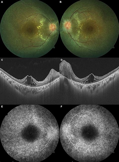 Double Trouble Exudative Hypertensive Retinopathy In A Patient With