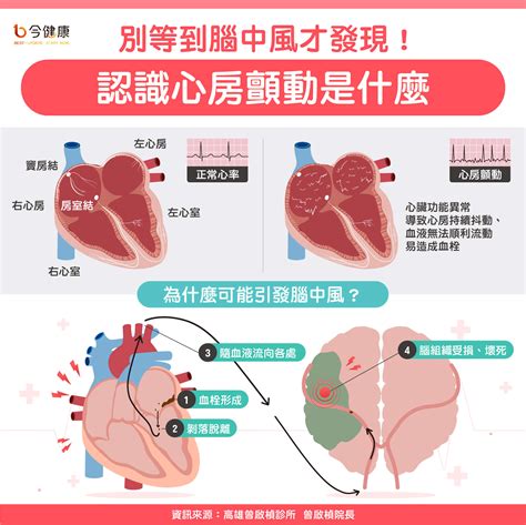 【世界心臟日專題報導】拒絕腦中風先認識心房顫動！及早發現還能防心衰竭！ Beanfun