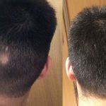 Patients Questions Hair Re Growth Programs The Beauty And Cosmetic