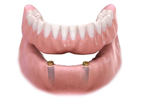 Implant Overdenture Tri State Oral Maxillofacial Surgery