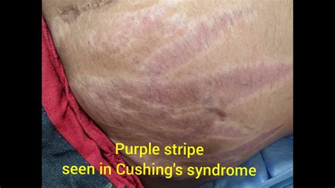 Purple Striae Cushings Syndrome Youtube