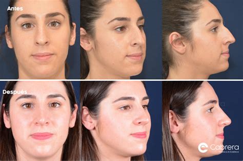 ¿cuál Es La Diferencia Entre Una Rinoplastia Ultrasónica Y Una Normal