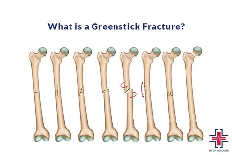 Greenstick Fracture: Causes, Symptoms, and Treatment | ER of Mesquite