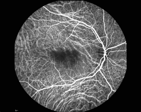 Angiograf A Con Verde De Indocianina Retina Y M Cula Consultores