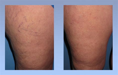 Before After Spider Veins Miller Vein Miller Vein