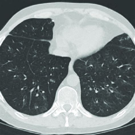 Chest Radiograph In Lung Transplant Recipient With Pneumocystis Download Scientific Diagram