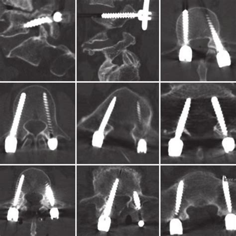 Pdf Does Navigation Improve Pedicle Screw Placement Accuracy Comparison Between Navigated And