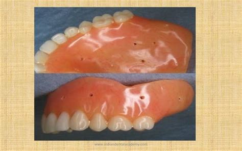 Relining And Rebasing In Complete Dentures Labial Orthodontics