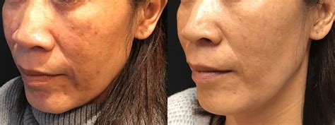 Melasma for Asian Woman Treated with Q-Switched Yag Laser Before ...