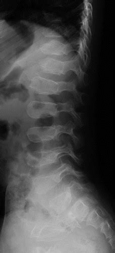 Radiologic Features Of Type Ii And Type Xi Collagenopathies Radiographics