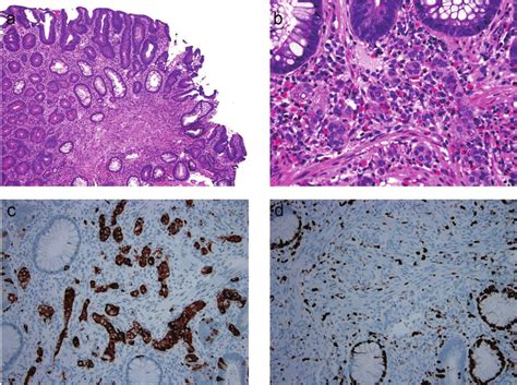 Composite Intestinal Adenoma Microcarcinoid Consists Of Colonic Adenoma