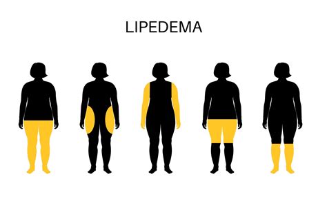 Qué es el Lipedema Clínica Bruselas