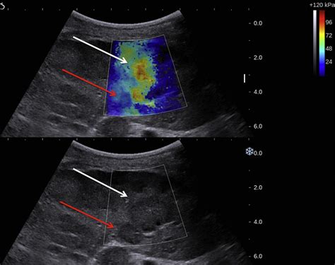 Elastography In Clinical Practice Radiologic Clinics