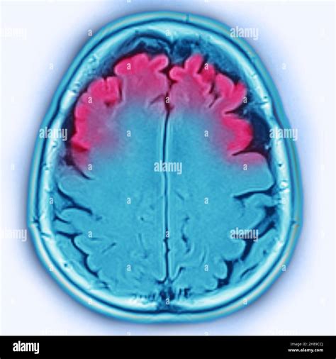 Brain atrophy alzheimer hi-res stock photography and images - Alamy