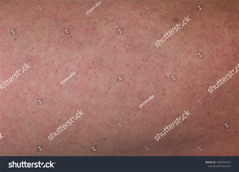 Close Human Skin Red Rashes Dengue Stock Photo 1606702504 Shutterstock