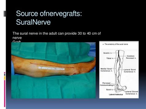 Hand nerve repair