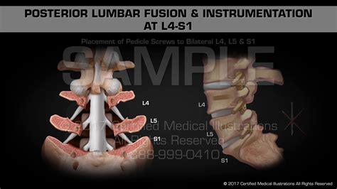 Posterior Lumbar Fusion