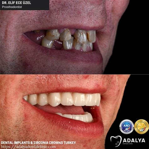 Dentistry Turkey Cosmetic Dentistry Antalya Adalya Dental Clinic