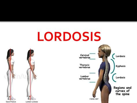 Kyphosis Lordosis