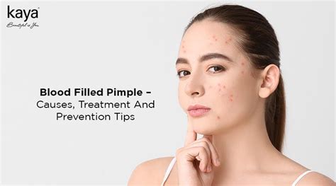 Blood Filled Pimples: Causes, Treatments, Prevention Tips - Blog