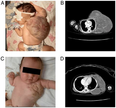 Case 1 Angio CT On Admittance A And B Vs At 9 Weeks Of Treatment C