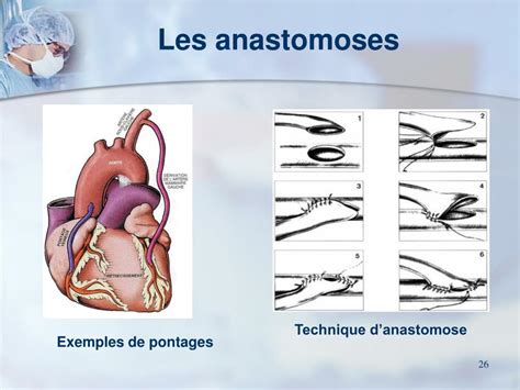 PPT La Chirurgie Cardiaque Des Coronaires Et Des Valves PowerPoint