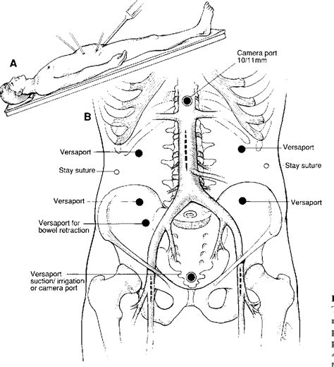 Figure 1 From Laparoscopic Aortobifemoral Bypass Semantic Scholar