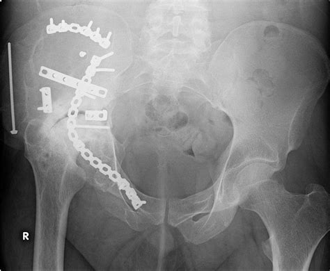 Sacral Fracture Treatment | Sacral Bone Fracture Surgery