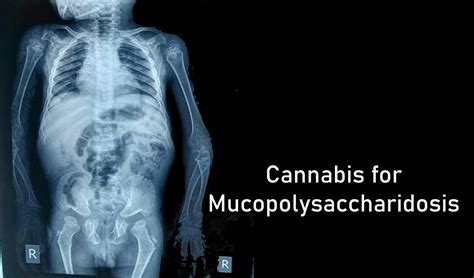 Cannabis For Mucopolysaccharidosis (Hurler Syndrome)