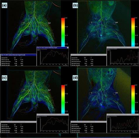 Color Coded Digital Subtraction Angiography For Assessing Acute