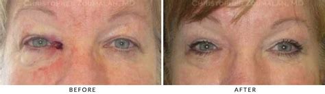 Eyelid Skin Cancer Excision Before and After Photo Gallery