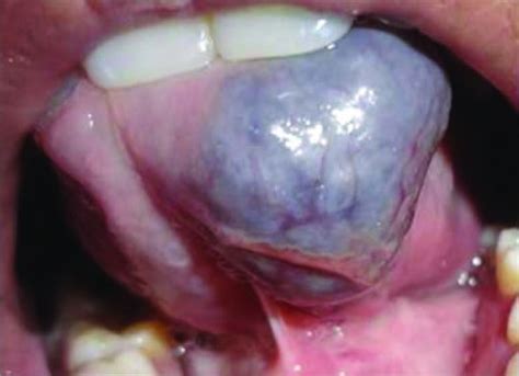 Cavernous Hemangioma Of Tongue Management Of Two Cases Abstract