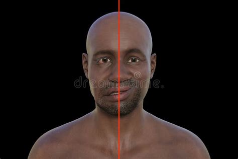 Facial Palsy In An African Man 3d Illustration Highlighting The Asymmetry And Drooping Of The