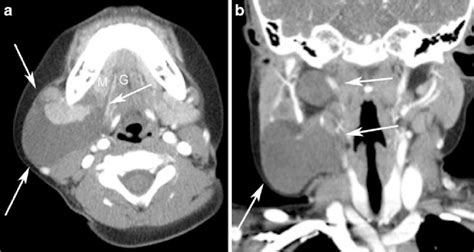 A 4 Year Old Boy With A Plunging Ranula Axial A And Coronal B