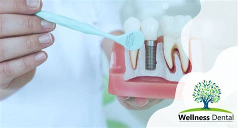 Effective Dental Implant Infection Treatment: Factors and Options