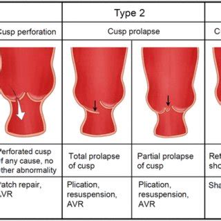 Aortic Regurgitation Grading