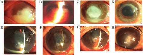 Preoperative and postoperative photographs of filamentary fungal... | Download Scientific Diagram