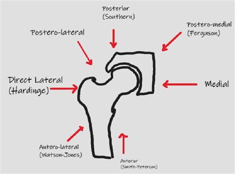 Surgical Approaches To Total Hip Arthroplasty Download Scientific Diagram